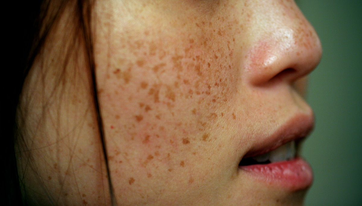 A person with freckles.