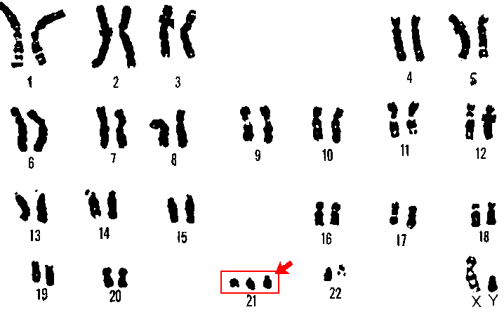 The karyotype for a person with Down syndrome, with an extra copy of chromosome 21.